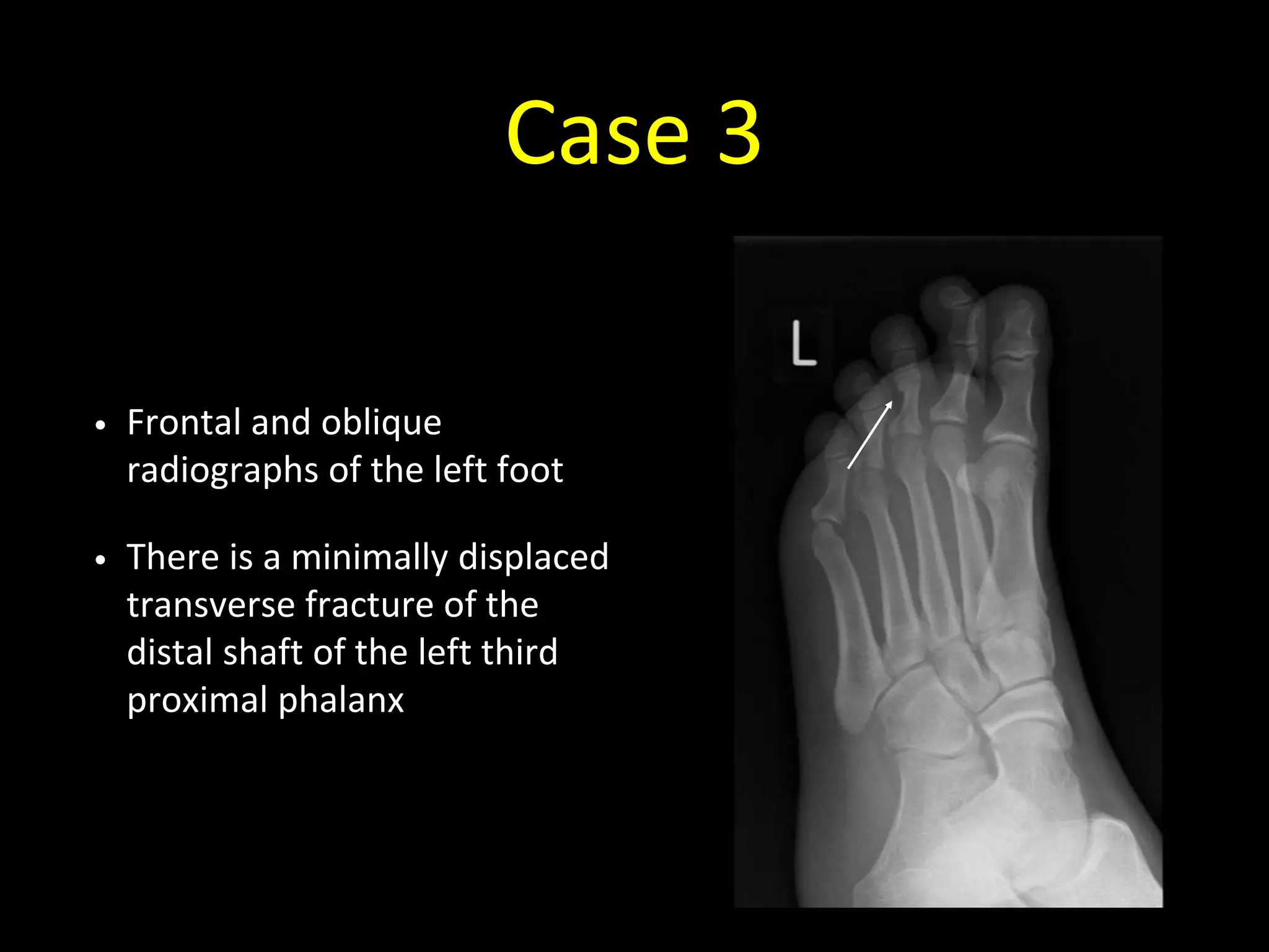 Case 3
• Frontal and oblique
radiographs of the left foot
• There is a minimally displaced
transverse fracture of the
distal shaft of the left third
proximal phalanx
 