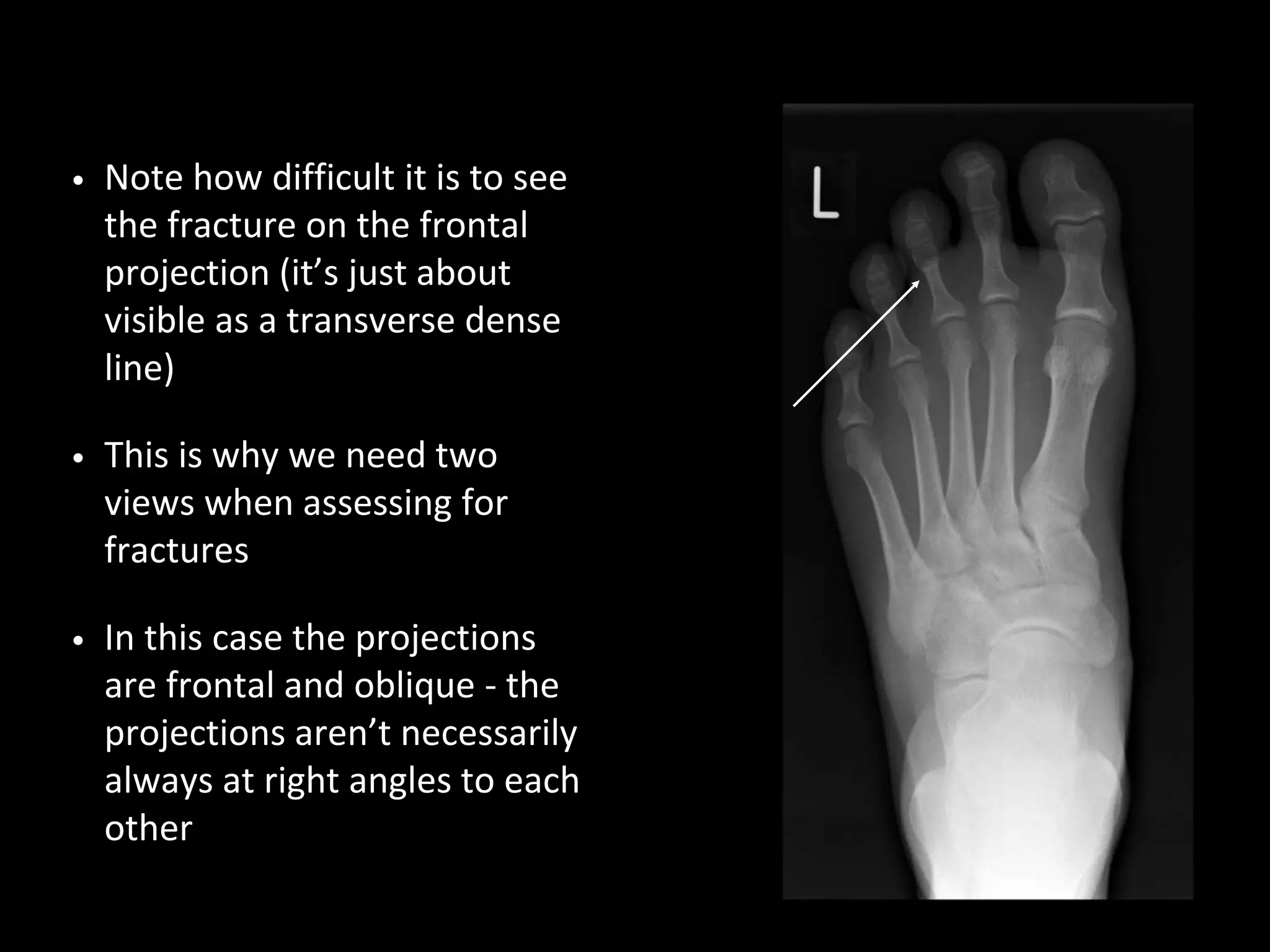 • Note how difficult it is to see
the fracture on the frontal
projection (it’s just about
visible as a transverse dense
line)
• This is why we need two
views when assessing for
fractures
• In this case the projections
are frontal and oblique - the
projections aren’t necessarily
always at right angles to each
other
 