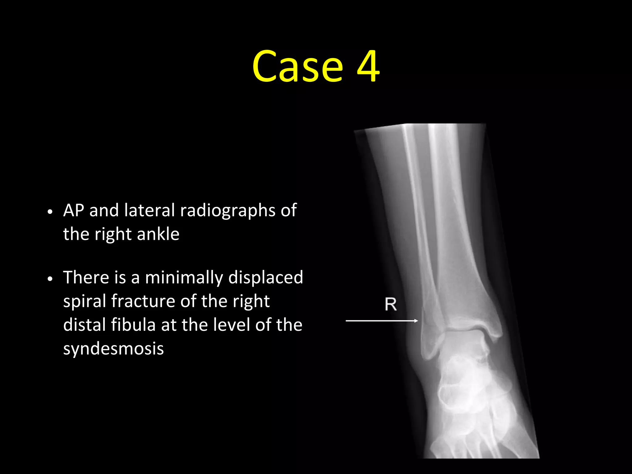 Case 4
• AP and lateral radiographs of
the right ankle
• There is a minimally displaced
spiral fracture of the right
distal fibula at the level of the
syndesmosis
 