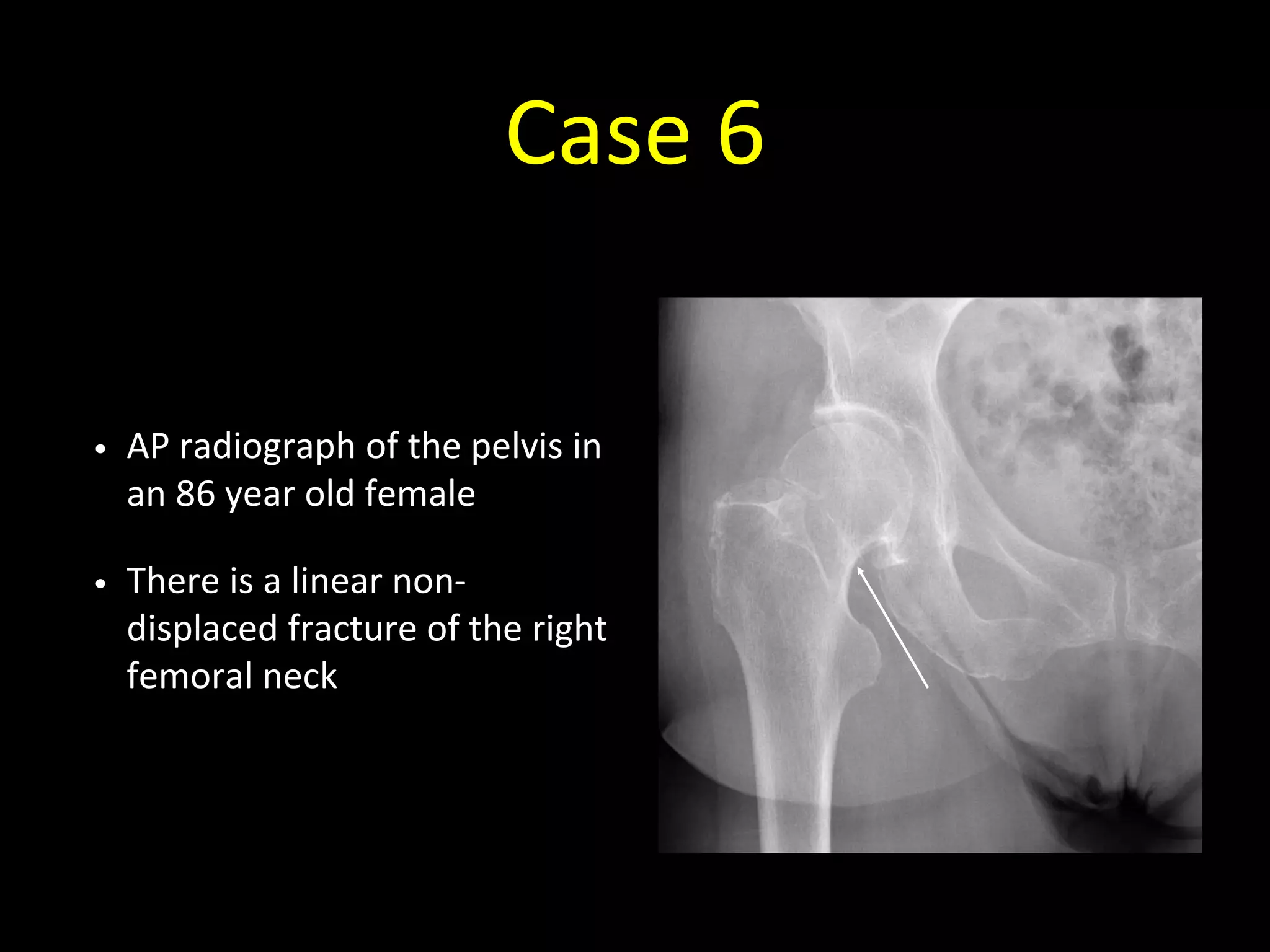 Case 6
• AP radiograph of the pelvis in
an 86 year old female
• There is a linear non-
displaced fracture of the right
femoral neck
 