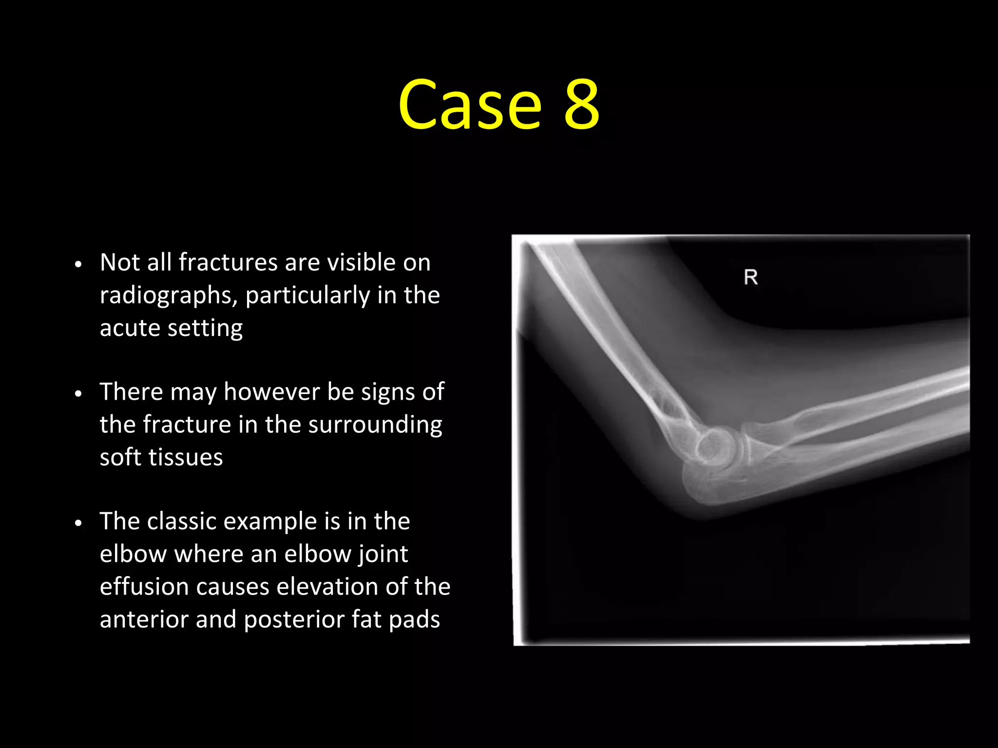 Case 8
• Not all fractures are visible on
radiographs, particularly in the
acute setting
• There may however be signs of
the fracture in the surrounding
soft tissues
• The classic example is in the
elbow where an elbow joint
effusion causes elevation of the
anterior and posterior fat pads
 