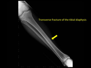 Transverse fracture of the tibial diaphysis
 