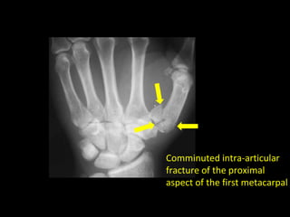 Comminuted intra-articular
fracture of the proximal
aspect of the first metacarpal
 