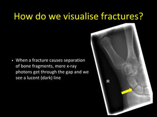 How do we visualise fractures?
• When a fracture causes separation
of bone fragments, more x-ray
photons get through the gap and we
see a lucent (dark) line
 