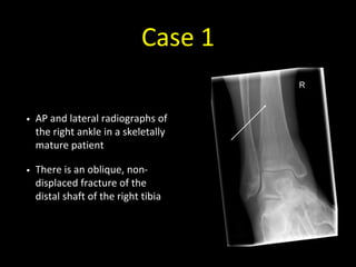 Case 1
• AP and lateral radiographs of
the right ankle in a skeletally
mature patient
• There is an oblique, non-
displaced fracture of the
distal shaft of the right tibia
 