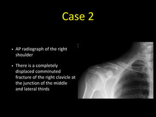 Case 2
• AP radiograph of the right
shoulder
• There is a completely
displaced comminuted
fracture of the right clavicle at
the junction of the middle
and lateral thirds
 