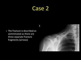Case 2
• The fracture is described as
comminuted as there are
three separate fracture
fragments (arrows)
 