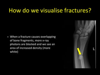 How do we visualise fractures?
• When a fracture causes overlapping
of bone fragments, more x-ray
photons are blocked and we see an
area of increased density (more
white)
 