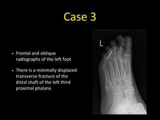 Case 3
• Frontal and oblique
radiographs of the left foot
• There is a minimally displaced
transverse fracture of the
distal shaft of the left third
proximal phalanx
 