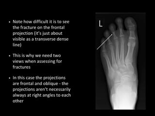 • Note how difficult it is to see
the fracture on the frontal
projection (it’s just about
visible as a transverse dense
line)
• This is why we need two
views when assessing for
fractures
• In this case the projections
are frontal and oblique - the
projections aren’t necessarily
always at right angles to each
other
 
