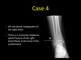 Case 4
• AP and lateral radiographs of
the right ankle
• There is a minimally displaced
spiral fracture of the right
distal fibula at the level of the
syndesmosis
 