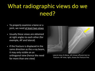 What radiographic views do we
need?
• To properly examine a bone or a
joint, we need at least two views
• Usually these views are obtained
at right angles to each other (for
example, AP and lateral)
• If the fracture is displaced in the
same direction as the x-ray beam,
it may only visible on an
orthogonal view (hence the need
for more than one view)
Lateral view of elbow, left shows effusion but no
fracture. AP view, right, shows the fracture line.
 