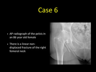 Case 6
• AP radiograph of the pelvis in
an 86 year old female
• There is a linear non-
displaced fracture of the right
femoral neck
 