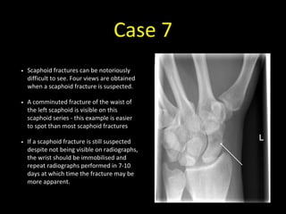 Case 7
• Scaphoid fractures can be notoriously
difficult to see. Four views are obtained
when a scaphoid fracture is suspected.
• A comminuted fracture of the waist of
the left scaphoid is visible on this
scaphoid series - this example is easier
to spot than most scaphoid fractures
• If a scaphoid fracture is still suspected
despite not being visible on radiographs,
the wrist should be immobilised and
repeat radiographs performed in 7-10
days at which time the fracture may be
more apparent.
 