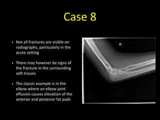 Case 8
• Not all fractures are visible on
radiographs, particularly in the
acute setting
• There may however be signs of
the fracture in the surrounding
soft tissues
• The classic example is in the
elbow where an elbow joint
effusion causes elevation of the
anterior and posterior fat pads
 