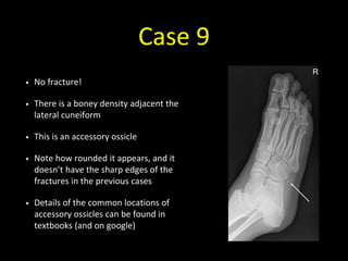 Case 9
• No fracture!
• There is a boney density adjacent the
lateral cuneiform
• This is an accessory ossicle
• Note how rounded it appears, and it
doesn’t have the sharp edges of the
fractures in the previous cases
• Details of the common locations of
accessory ossicles can be found in
textbooks (and on google)
 
