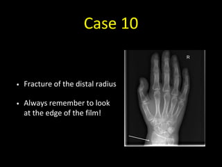 Case 10
• Fracture of the distal radius
• Always remember to look
at the edge of the film!
 