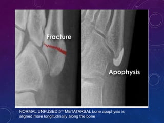 fracture-lower-limb-pptx
