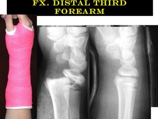 Fx. Distal Third
Forearm
 