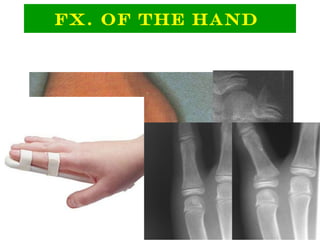 Fx. Of The Hand
 