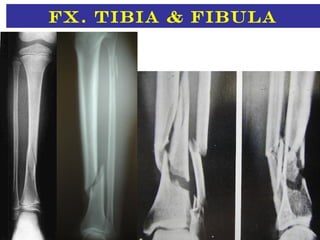Fx. Tibia & fibula
 