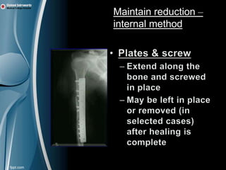 Maintain reduction –
internal method
 