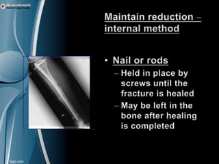 fracturemanagement-w-100423032635-phpapp01 (1).pptx