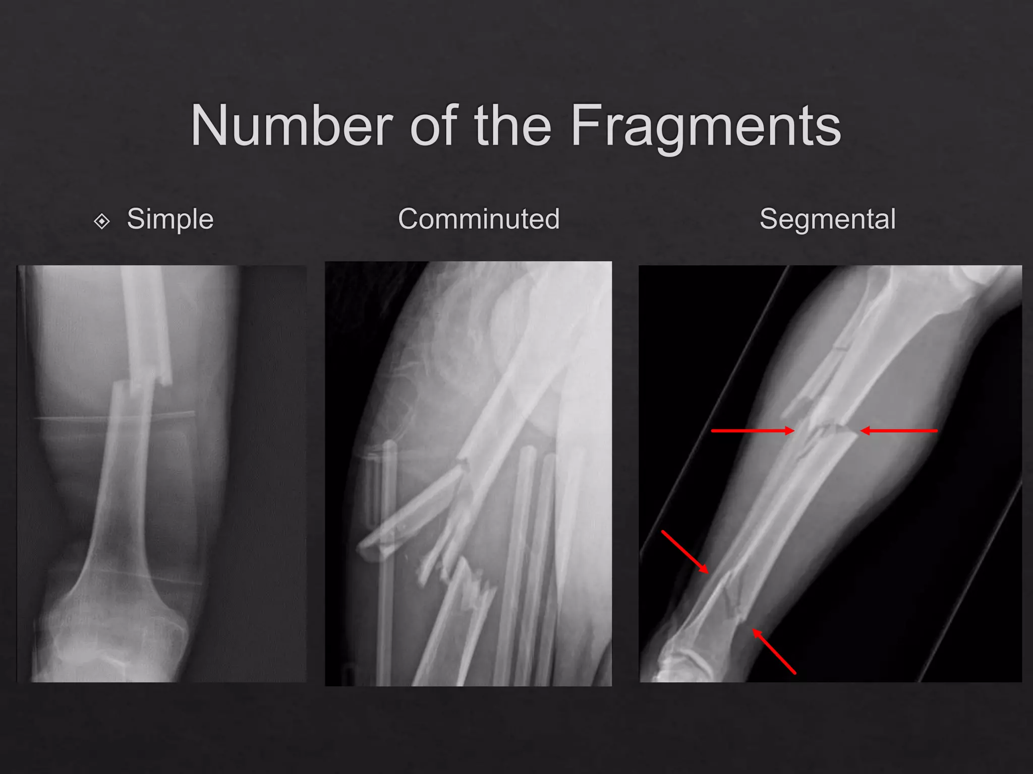 Fracture Management and Immobilization Techniques.pptx
