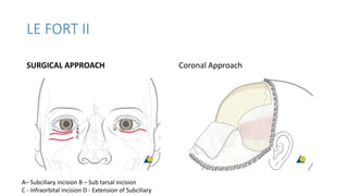 Subciliary Approach Incision Fracture maxilla | PPTX