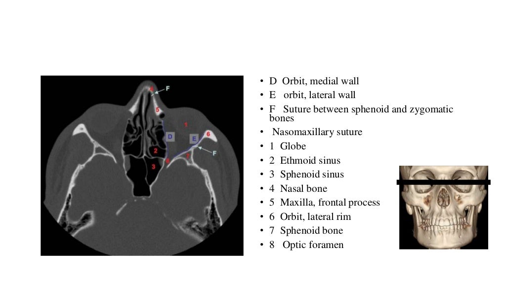 Fracture maxilla