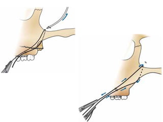 Comprehensive Radiographic Evaluation and Management of LeFort ...