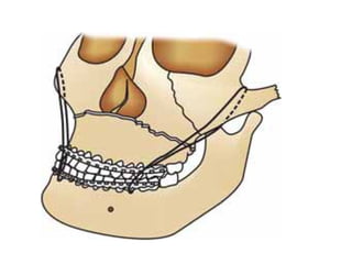 Comprehensive Radiographic Evaluation and Management of LeFort ...
