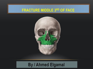FRACTURE MIDDLE 3RD OF FACE
 