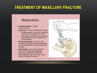 Mid facial fractures ( Mid facial trauma ) | PPTX
