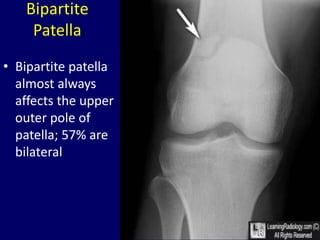 Fracture Mimics Dr. Muhammad Bin Zulfiqar | PPTX