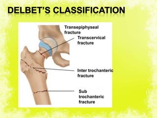 4/17/2014 17
Transepiphyseal
fracture
Inter trochanteric
fracture
Sub
trochanteric
fracture
Transcervical
fracture
 