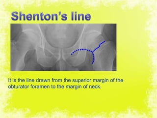 4/17/2014 22
It is the line drawn from the superior margin of the
obturator foramen to the margin of neck.
 