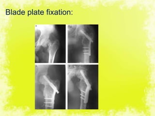 4/17/2014 31
Blade plate fixation:
 