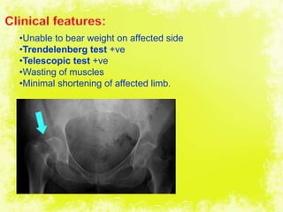 4/17/2014 35
•Unable to bear weight on affected side
•Trendelenberg test +ve
•Telescopic test +ve
•Wasting of muscles
•Minimal shortening of affected limb.
 