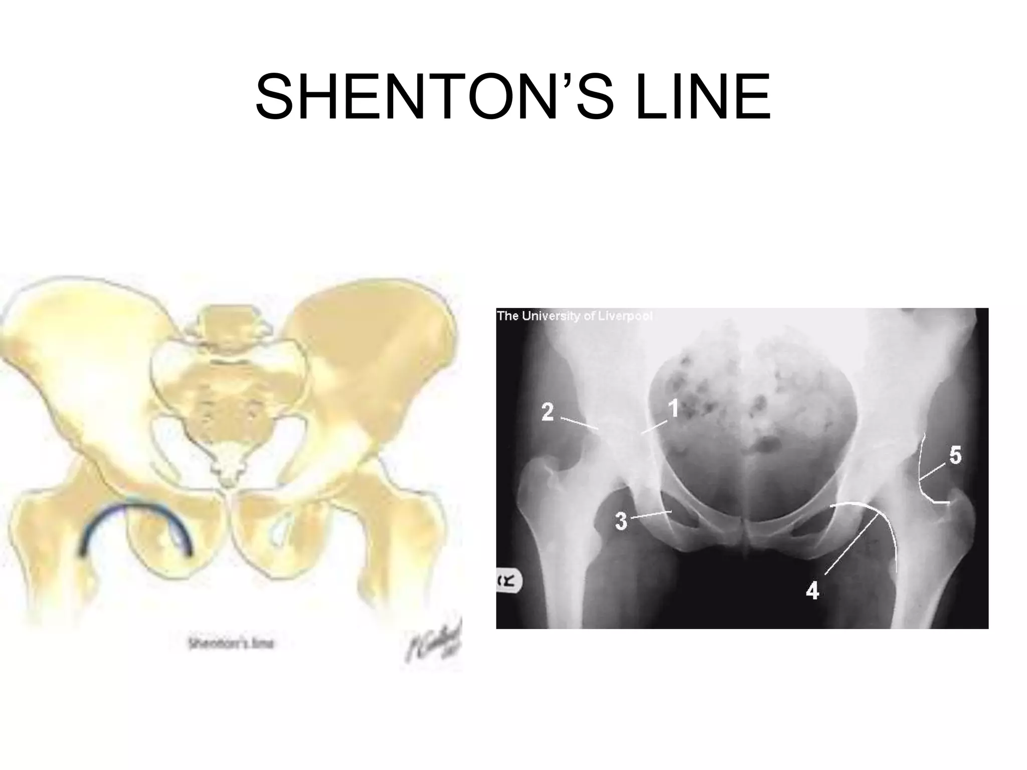 Stenton Line Fracture neck femur | PPT