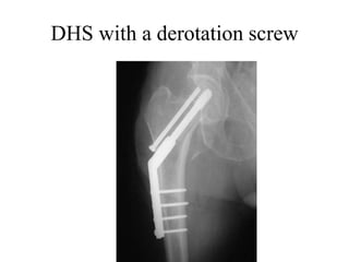 Fracture neck femur | PPT