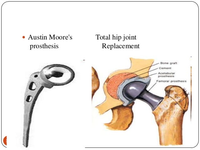 Moore prothesis