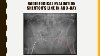 Stenton Line Fracture Neck of Femur Clinic al features.pptx