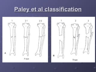 Comprehensive Overview of Non-Union Fractures: Definitions, Causes, and ...
