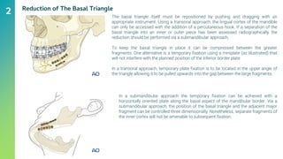 Fractures of The Body of The Mandible In Maxillofacial Surgery | PDF
