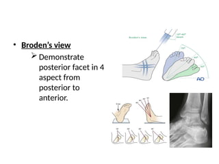 Fracture Of Calcaneum and Talus trea.pptx