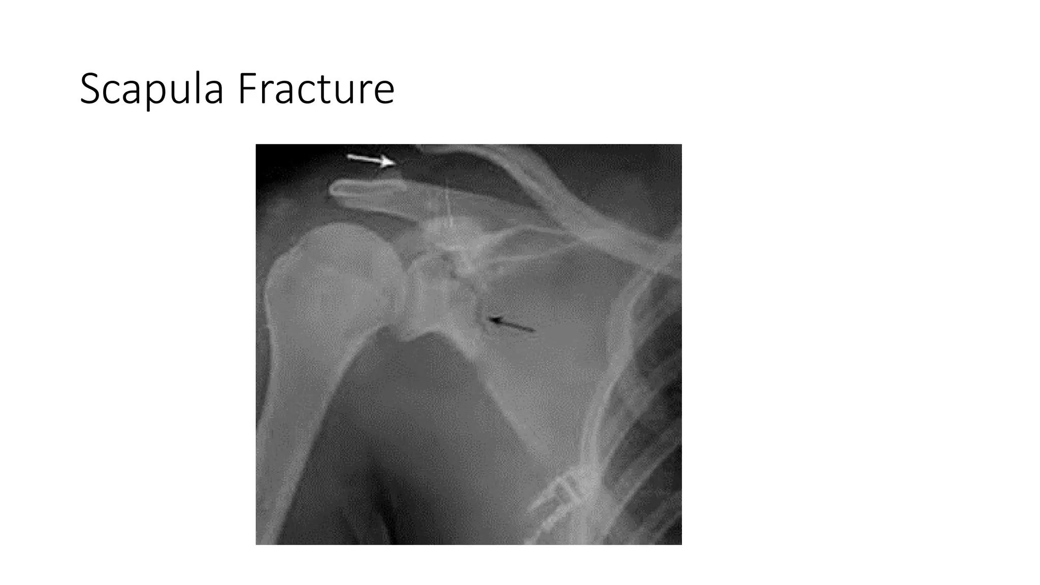 Fracture of Clavicle and Scapulawie.pptx