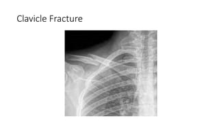 Fracture of Clavicle and Scapulawie.pptx