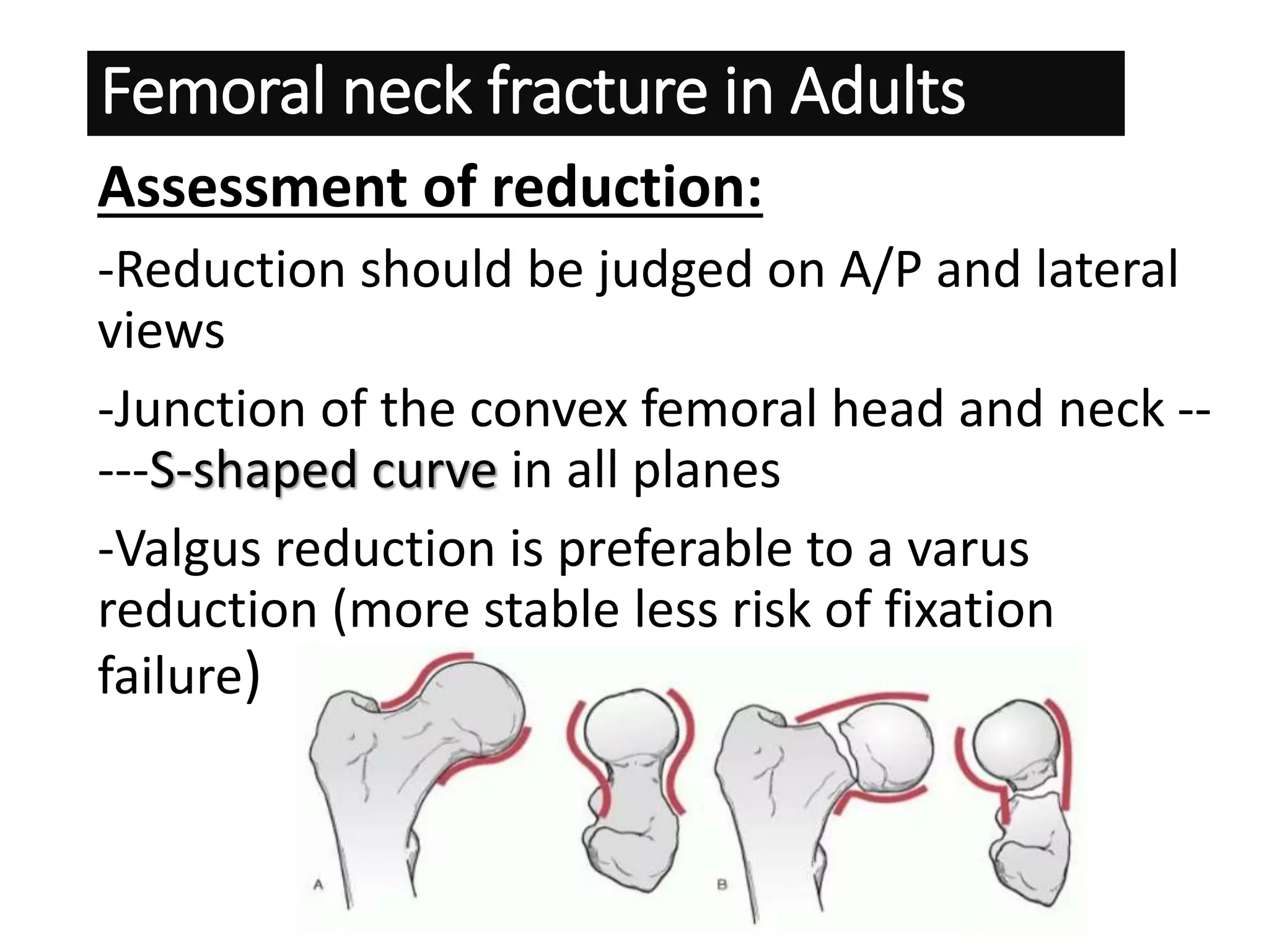Fracture Of Femoral Neck In Adults.pptx