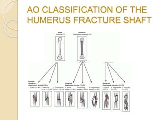 AO CLASSIFICATION OF THE
HUMERUS FRACTURE SHAFT
 